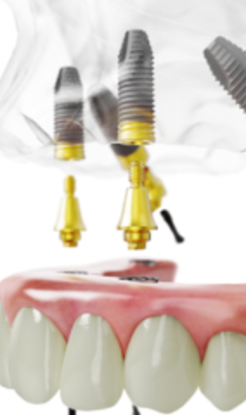 Kép - Implantáció – egyedi technika