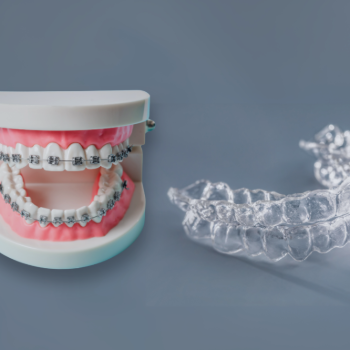 Fogszab�lyoz� t�pusok - R�gz�tett vagy kivehet�?