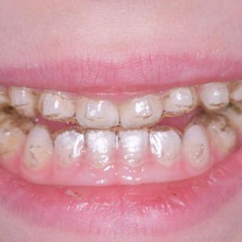 Mire val�k az attachmentek fogszab�lyoz�skor? 