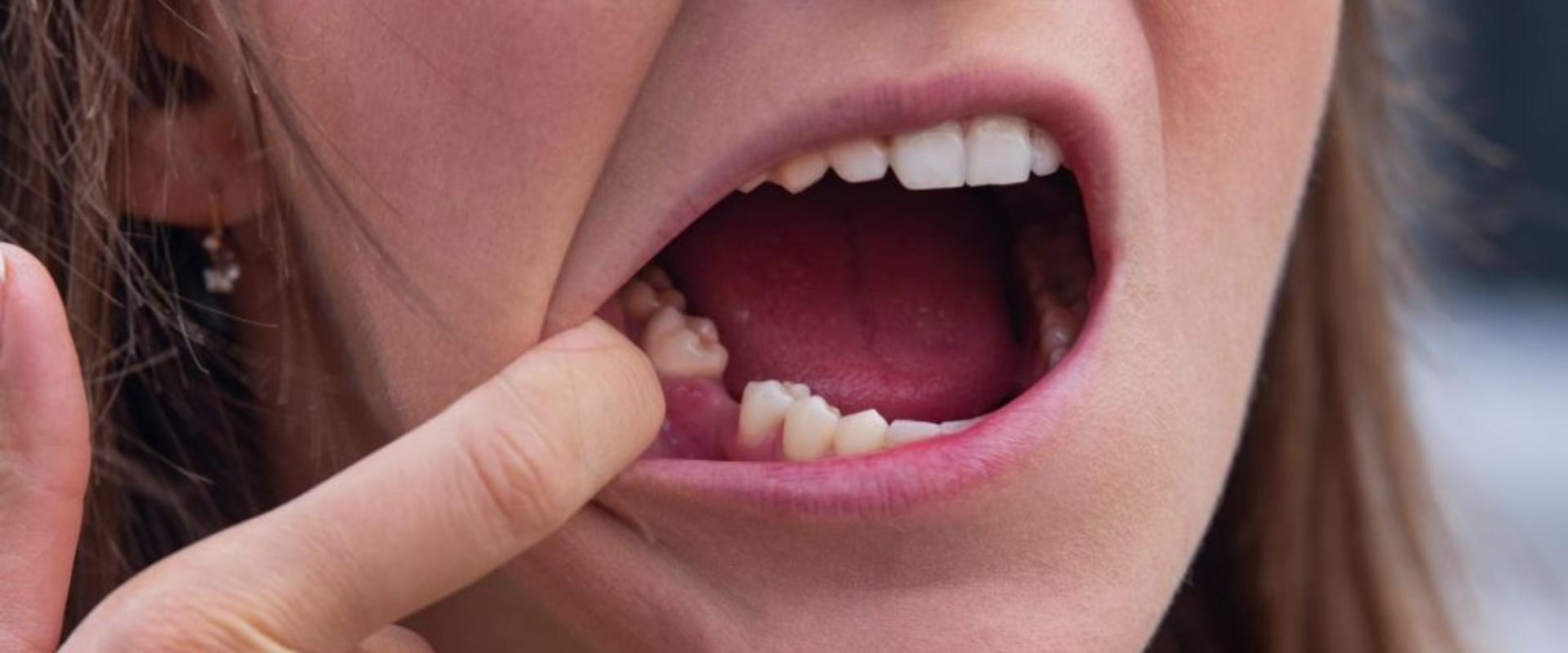 Foghiány kezelése az Invisalign segítségével - Innováció és esztétika egyben Foghiány kezelése az Invisalign segítségével - Innováció és esztétika egyben