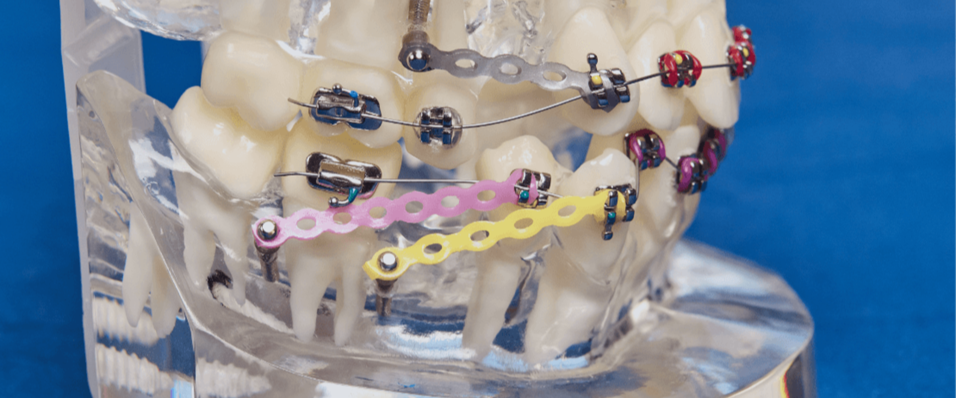 Fogszabályozás foghúzás nélkül Fogszabályozás foghúzás nélkül