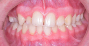 lathatatlan fogszabalyozas elotti allapot szabalytalan fogsor