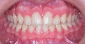 lathatatlan fogszabalyozas ut�ni allapot szabalyos fogsor