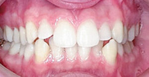 lathatatlan fogszabalyozas elotti allapot szabalytalan fogsor