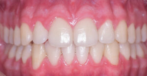 lathatatlan fogszabalyozas ut�ni allapot szabalyos fogsor