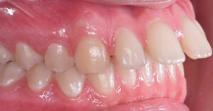 lathatatlan fogszabalyozas elotti allapot szabalytalan fogsor