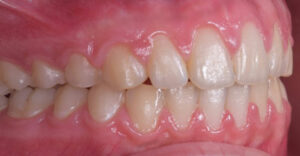 lathatatlan fogszabalyozas ut�ni allapot szabalyos fogsor