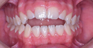 lathatatlan fogszabalyozas elotti allapot szabalytalan fogsor