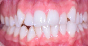 lathatatlan fogszabalyozas elotti allapot szabalytalan fogsor