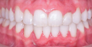 lathatatlan fogszabalyozas ut�ni allapot szabalyos fogsor